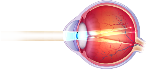 astigmatismo-laser-ocular