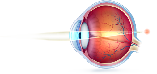 hipermetropia-laser-ocular