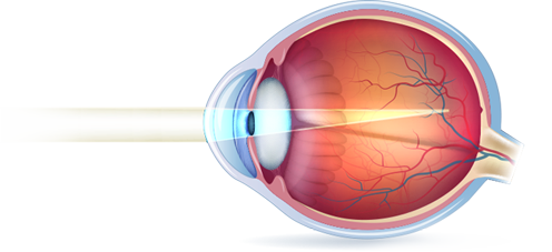 miopia-laser-ocular
